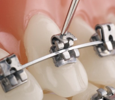 Self-ligating braces – New breakthrough in bracket system?